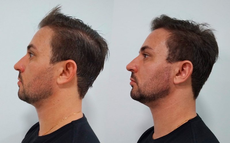 Luiza Jeha - Harmonização facial